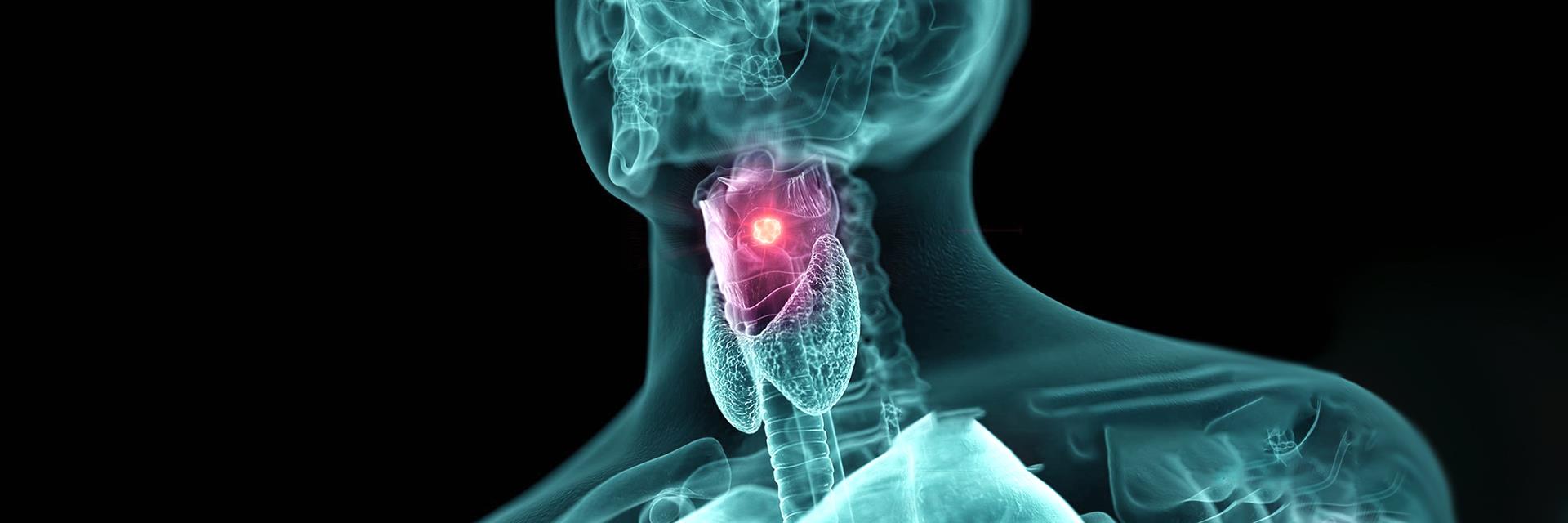 Tumors / Laryngeal Cancer