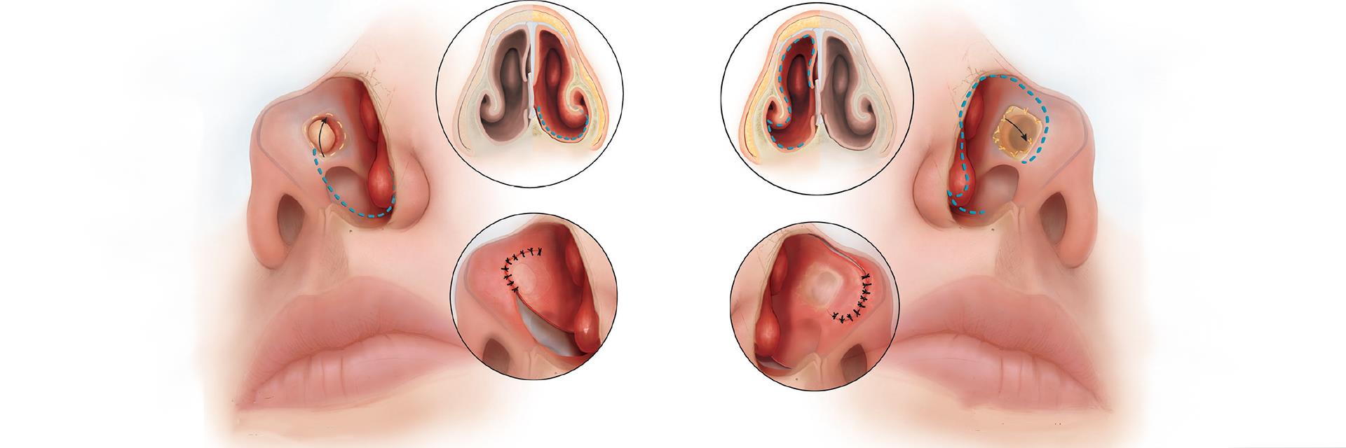 Nasal Diaphragm Drilling / Rehabilitation