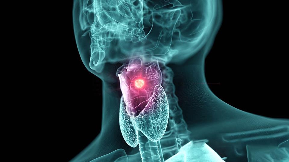 Tumors / Laryngeal Cancer