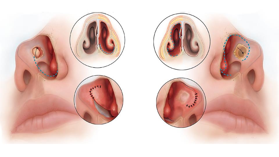 Nasal Diaphragm Drilling / Rehabilitation