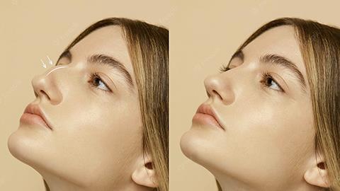 Rhinoplasty