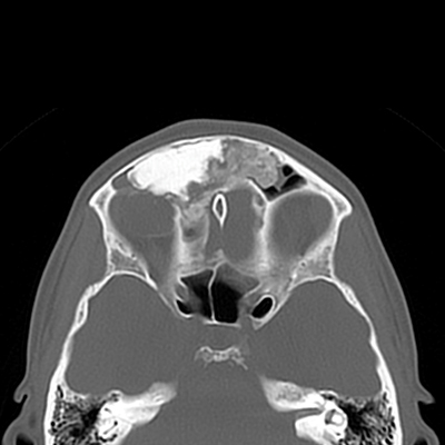 osteoma metopiaiou kolpou