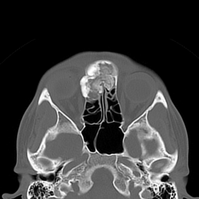 osteoma metopiaiou kolpou 2